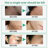 Scar Removal Cream